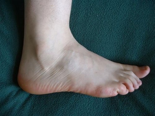 Mehr Schlaganfälle beim Restless-Legs-Syndrom