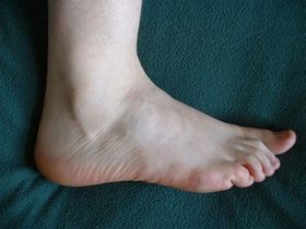 Mehr Schlaganfälle beim Restless-Legs-Syndrom